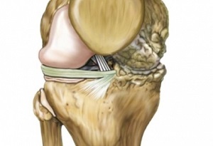 Enfermedad articular